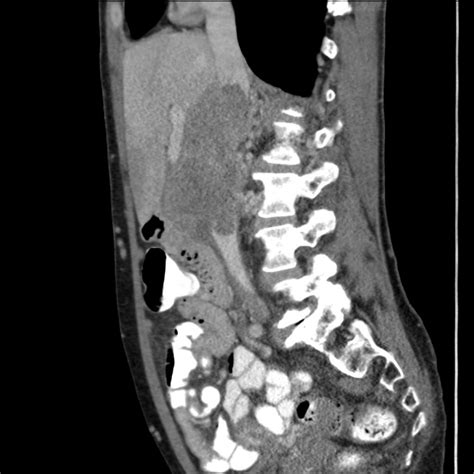 Primary Leiomyosarcoma Of Inferior Vena Cava Eurorad