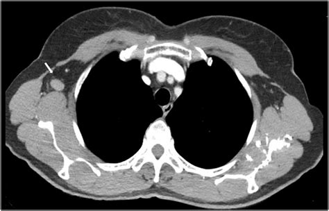 Ct Scan Of Chest Showing Bilateral Enlarged Axillary