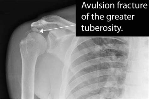 Avulsion Fracture Greater Tuberosity Humerus