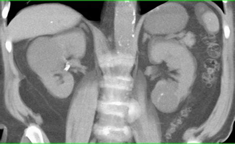 1 Cm Renal Cell Carcinoma In Lower Pole Of Left Kidney With Renal Cysts