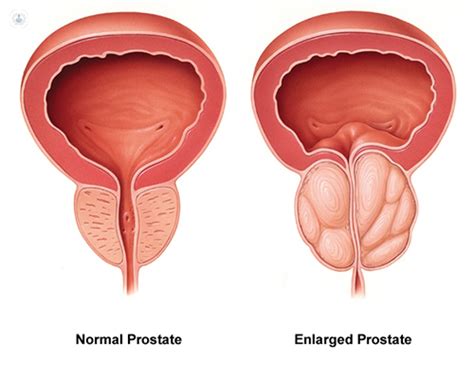 Everything You Need To Know About Prostate Cancer