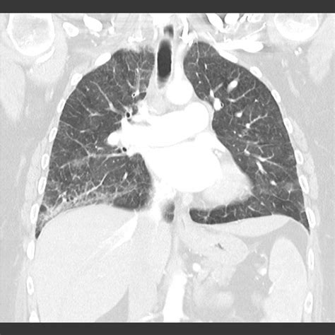 Pulmonary Veno Occlusive Disease Image