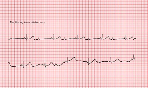 Cardio Fr Congenital Long Qt Syndrome Second Degree A V Block