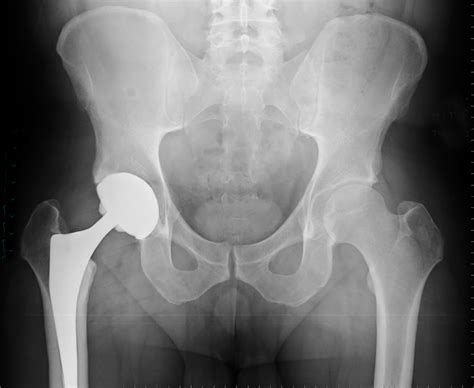 Depuy Asr Xl Hip Implant Sheller Pc Law Firm