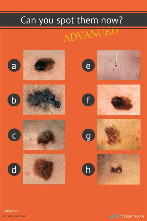 Can You Spot The Cancerous Mole Online Dermatology Cancerous Moles