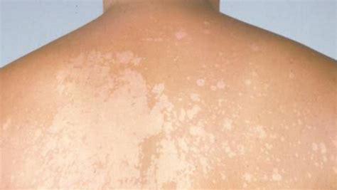 White Spots On The Skin Dangerous With Pictures