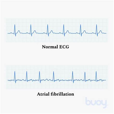 New Pocket Pill 94 Effective For Atrial Fibrillation