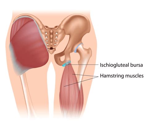 What Is Ischial Bursitis What Symptoms Can You Expect Upswing Health