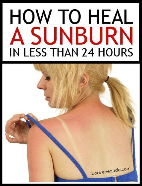 How To Heal A Sunburn In Less Than 24 Hours With Images Heal