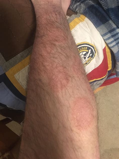 Wondering What These Weird Rashes All Of My Legs Dermatology