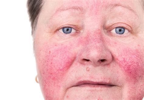 Top 3 best face wash for rosacea reviews. New rosacea therapies show promise | Dermatology Times and ...