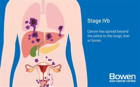 What Is Cervical Cancer Cervical Cancer Explained — Bowen Icon Cancer