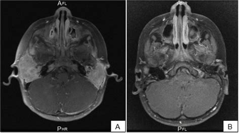 Axial View Of Post Contrasted T1 Mri Images A The Image Shows The