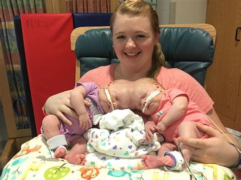 Conjoined Mooresville Twins Doing Well After Separation News