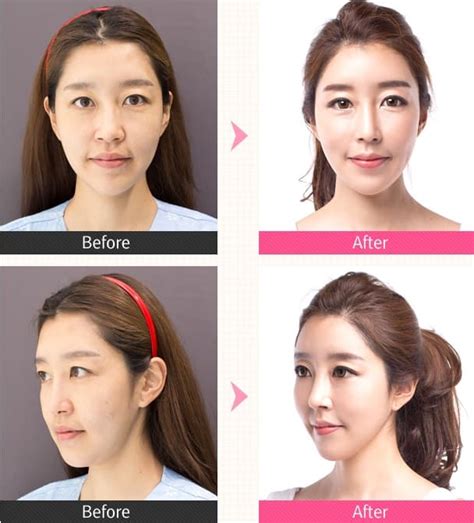 Korean Plastic Surgery Before After