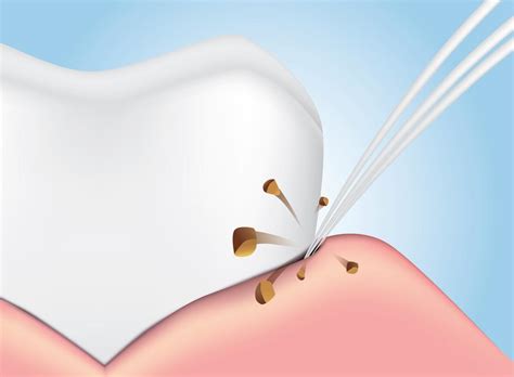 How A Professional Deep Cleaning Treats Gum Disease Dr Raminder Singh