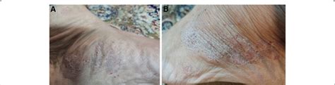 Palmoplantar Pustular Psoriasis Scaly Plaque With Punctuated