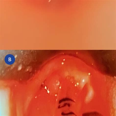 A Status Post Incision And Drainage Of Left Retropharyngeal Abscess Download Scientific