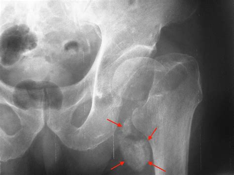 Medview Medical Imaging Consultancy Info Page Calcific Bursitis