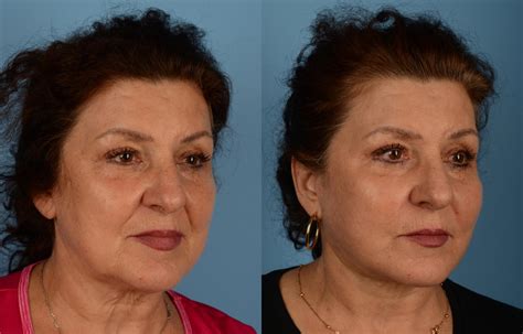 facelift neck lift before and after pictures case 168 toronto on ford plastic surgery dr