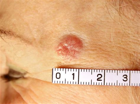Basal Cell Skin Cancer Basalioma Causes Symptoms And Treatment