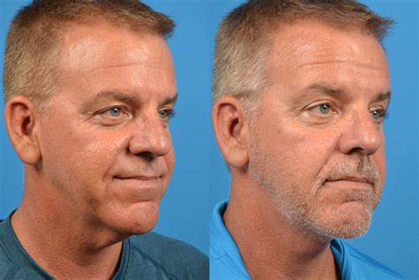 Patient 122406479 Profile Neck Lift Before And After Photos Clevens