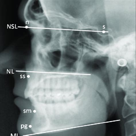 Pdf Craniofacial Morphology And Upper Airway Dimensions In Patients