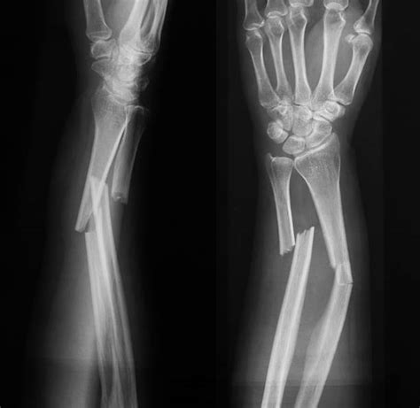 Broken Forearm X Ray