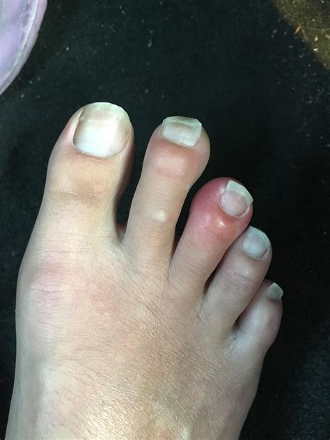 Middle Toe Looks Inflamed Not Sure Whats Going On Rfootfunction
