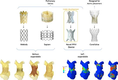 Patient Specific Modeling Of The Implantation Of Four Different Valves