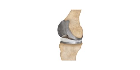 Best Knee Replacement Hardware