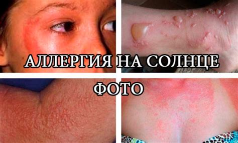 What Are The Causes Of Sun Allergy Estet Portal
