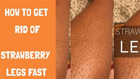 Strawberrylegs Keratosispilaris How To Get Rid Of Strawberry Legs
