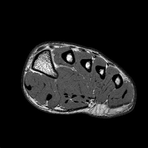 Abductor hallucis, flexor digitorium brevis, abductor digiti minimi 2nd layer: Normal foot MRI | Image | Radiopaedia.org