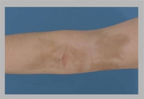 Skin Staining Due To Intravenous Iron Extravasation In A Teenager With