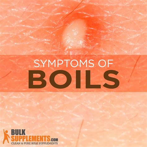 Boils Symptoms Causes And Treatment