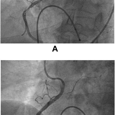 Panel A Showing Selective Cannulation Of Rca Using Al 2 Catheter Rca