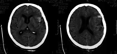 Figure 1 One Hour After Brain Injury Cerebral Contusion With