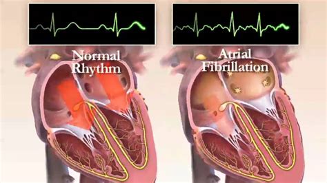 What Is Atrial Fibrillation Chapter Hrs Patient Video Youtube