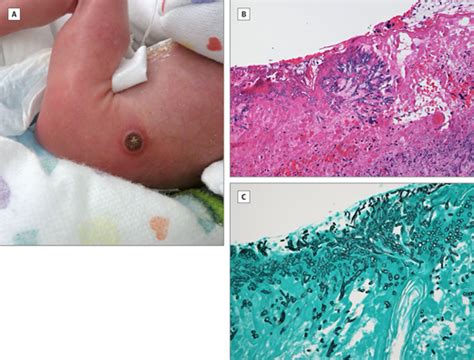 A Crusted Papule In A Premature Neonate Dermatology Jama Pediatrics