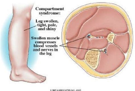Chronic Exertional Compartment Syndrome Non Surgical Treatment