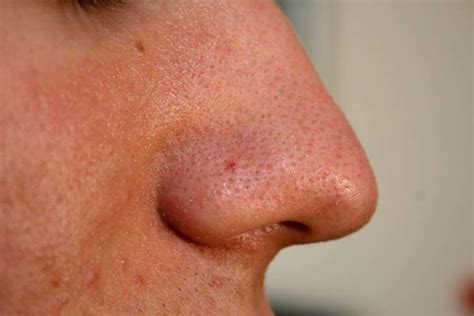 Understanding Sebaceous Filaments And How To Reduce Their Appearance