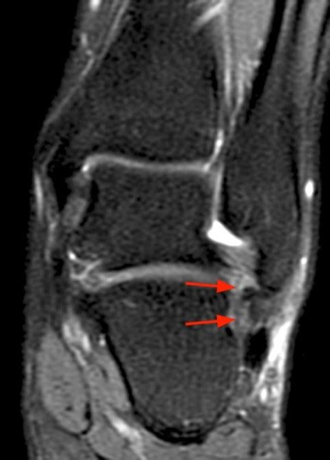 Other ligaments in the body include the: The Calcaneofibular Ligament - Radsource