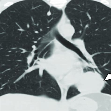 Pchest Computed Tomography Showing A Soft Tissue Mass 5 X 35 X 24