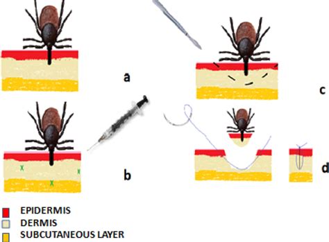 Surgical Tick Removal Wilderness And Environmental Medicine