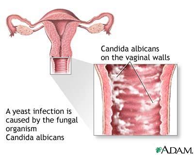 White Discharge And Yeast Infection Women Health Info Blog