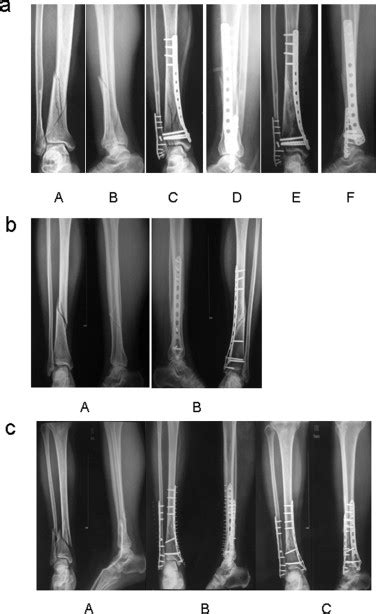 Comparison Of Minimally Invasive Percutaneous Plate Osteosynthesis With