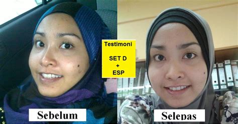 May 15, 2014 by snsprojects leave a comment. Cara Hilangkan Jeragat Dengan Selamat Cepat | Vitamin ...