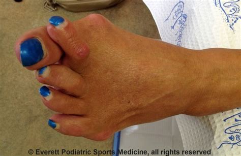 Symptoms Of Hammertoes And How To Treat Them Everett Podiatric Sports