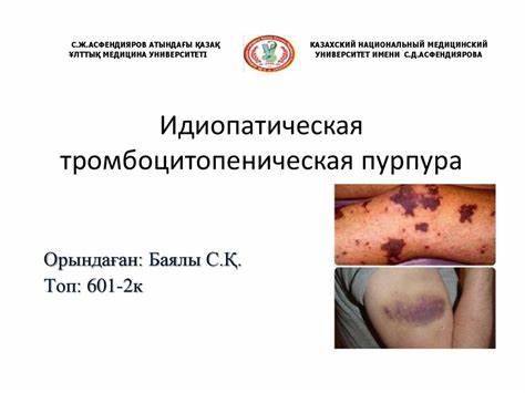 Тромбоцитопеническая пурпура диета Идиопатическая тромбоцитопеническая пурпура - презентация онлайн Идиопатическая тромбоцитопеническая пурпура - презентация онлайн Тромбоцитопеническая пурпура диета